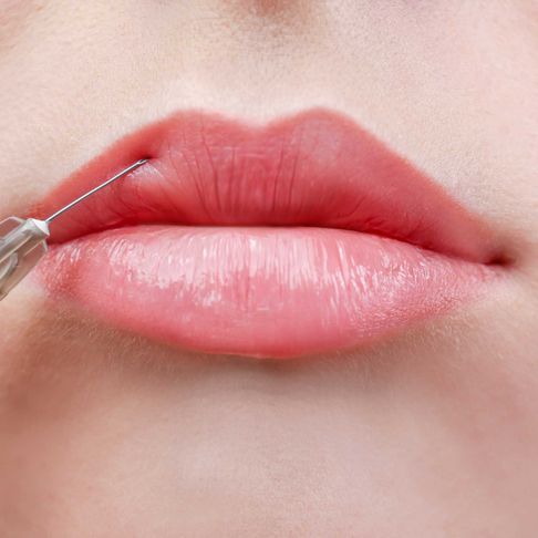 dermal filler aldershot, hampshire lip enhancement